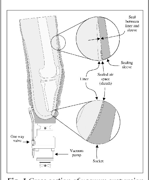 Vacuum-Assisted Suspension Systems