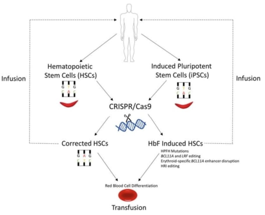 Application ofCRISPR Technology for the treatment of Sickle cell disease